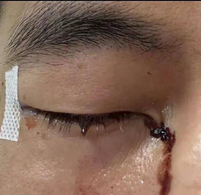 转眼罩已能取下还与朱芳雨一块吃路边烧烤ayx爱游戏体育网页版入口郭艾伦伤情好(图4)